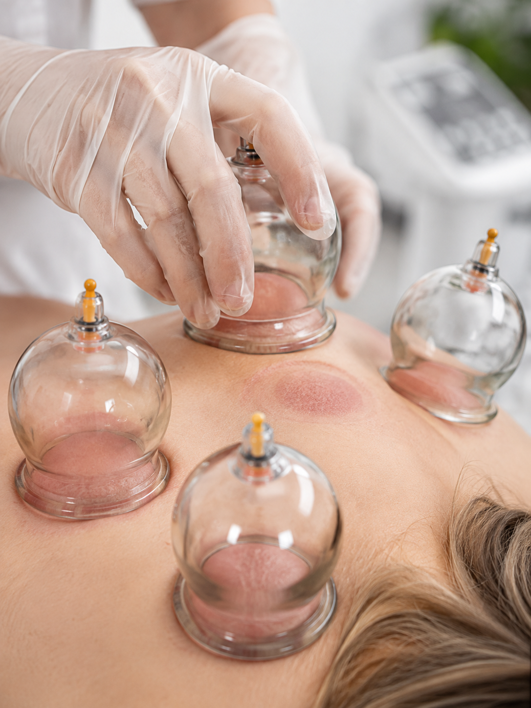 Wet cupping treatment in progress